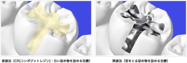 直接法（CR[コンポジットレジン]：白い詰め物を詰める治療）、間接法（型をとる詰め物を詰める治療）